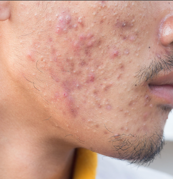 Breakouts & blemishes